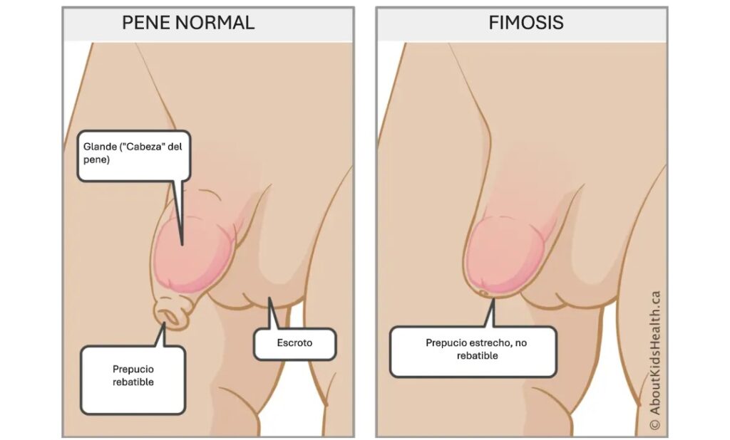 Comparación Fimosis vs Pene normal