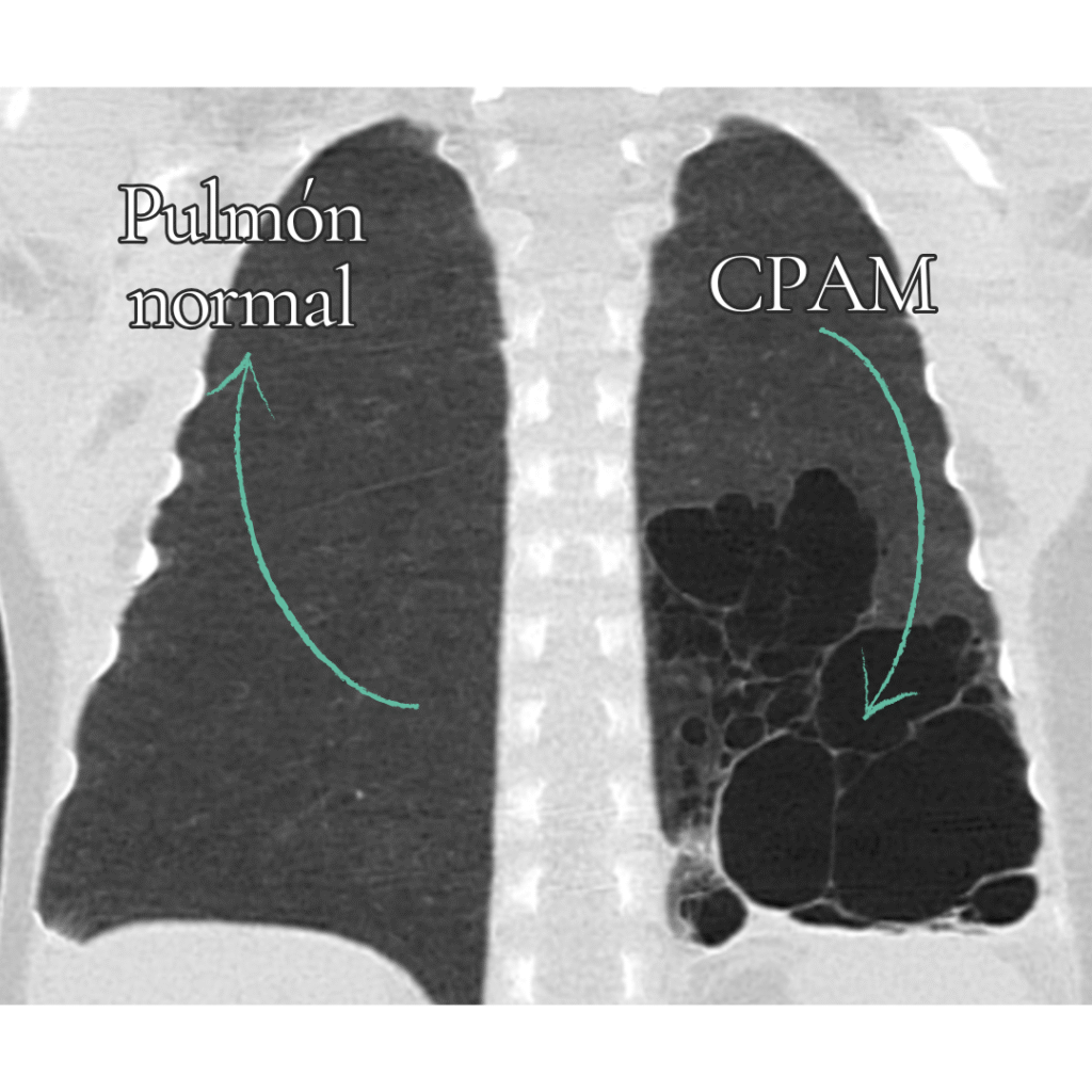 Tomografía de Paciente con Malformación Congénita Pulmonar