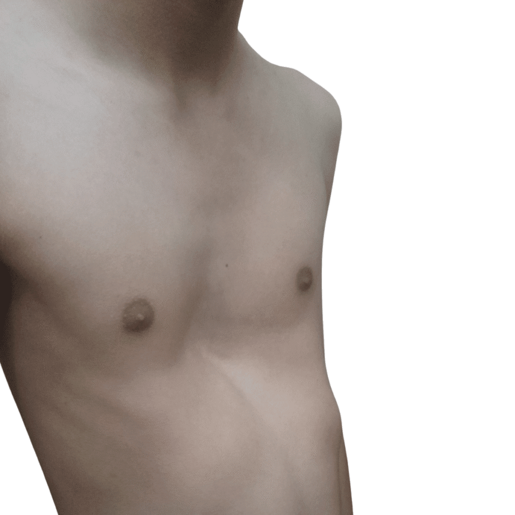 Pectus Excavatum