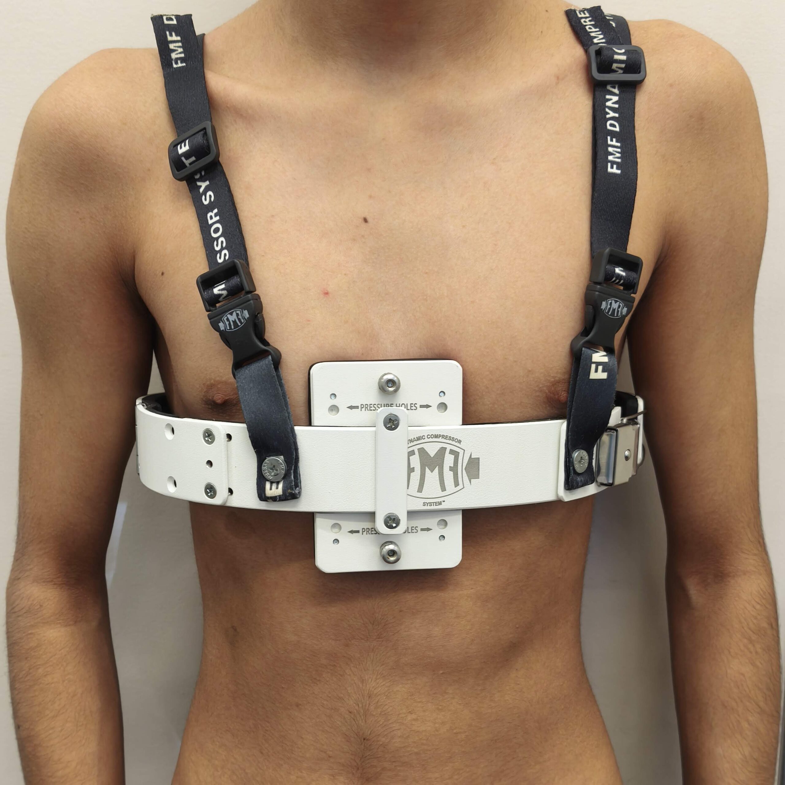 Tratamiento para Pectus Carinatum en adolescentes