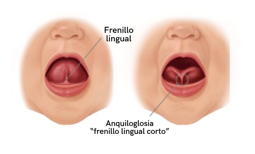 frenillo lingual corto
