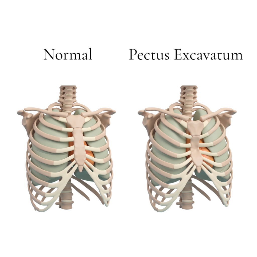 Pectus Excavatum